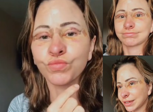 Woman Sold Home & Lives In Van To ‘Cushion’ $14,000 Face Lift Procedure That Makes Her Look Younger