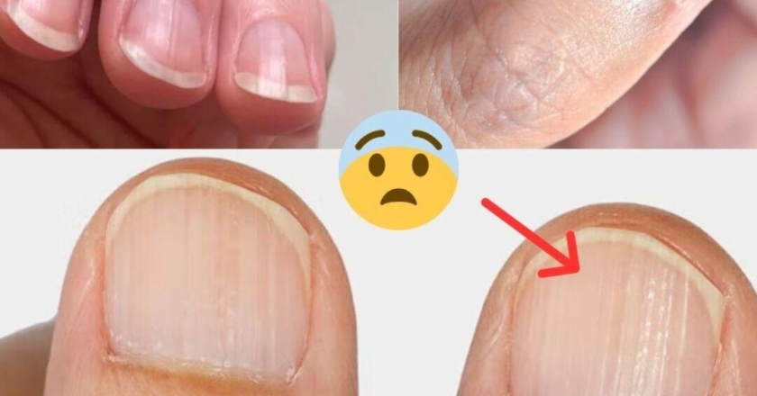 Doctor Reveals 7 Health Issues Hidden in Your Nails — What They Could Be Telling You