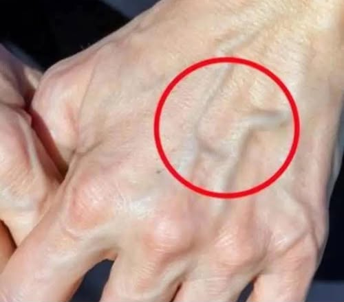 When to Worry About Veins That Appear Out of Nowhere!