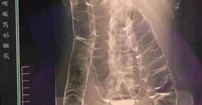 Why Your Constipation Problem Deserves Serious Attention